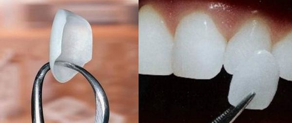 牙齿贴面分类有哪些？
