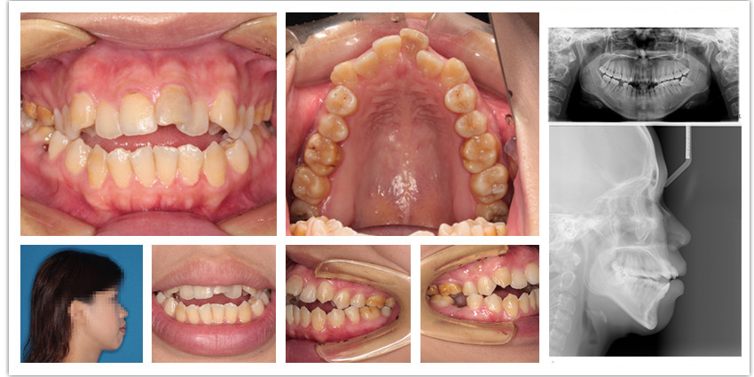 前牙排列不齐开颌牙齿矫正案例