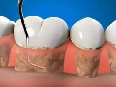 牙结石该怎么去除更合适?