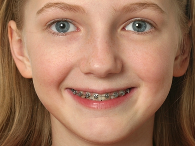 青少年歪牙能不能做牙齿美容