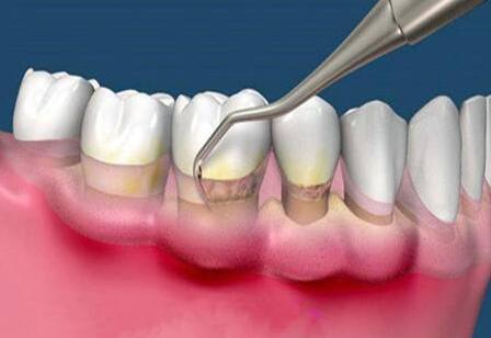 洗牙对治疗牙周病有效果吗