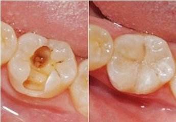 补牙是怎样的一个过程