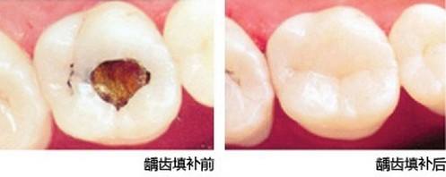 补牙洞材料哪种比较好？
