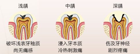 蛀牙会引起牙龈炎吗？