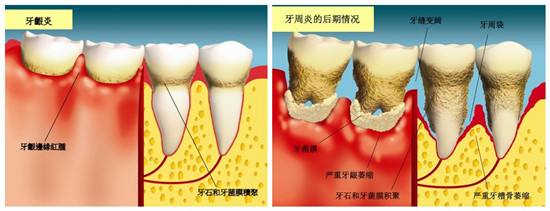 牙周炎与牙龈炎的区别有哪些？