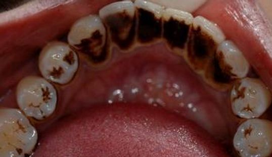 牙齿变色牙缝变黑是什么原因？