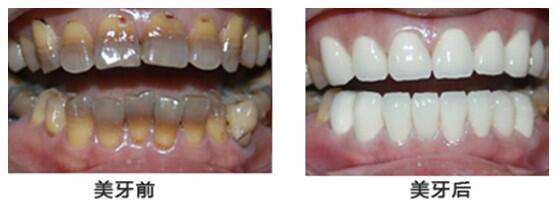 牙齿变色牙缝变黑是什么原因？