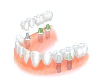 后牙种植牙一般多少钱？
