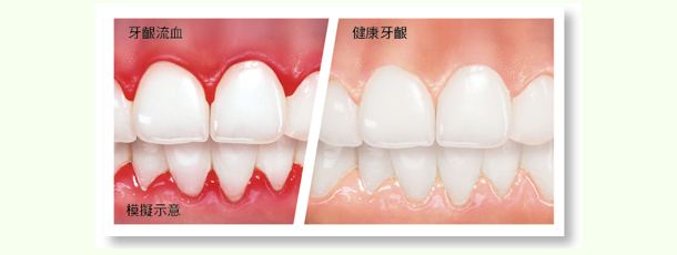 正常牙龈和牙龈炎的区别有哪些？