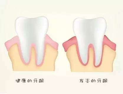 正常牙龈和牙龈炎的区别有哪些？