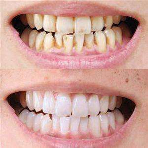 牙齿变色是不是坏死？该怎么修复呢？