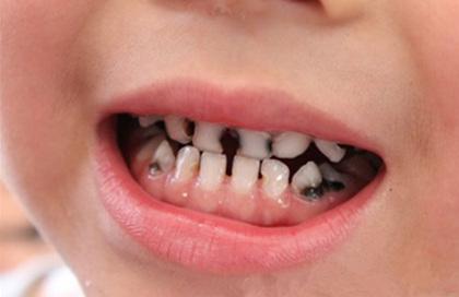 治疗儿童龋齿的费用一般是多少？