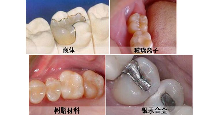 补牙洞一般都用什么材料？