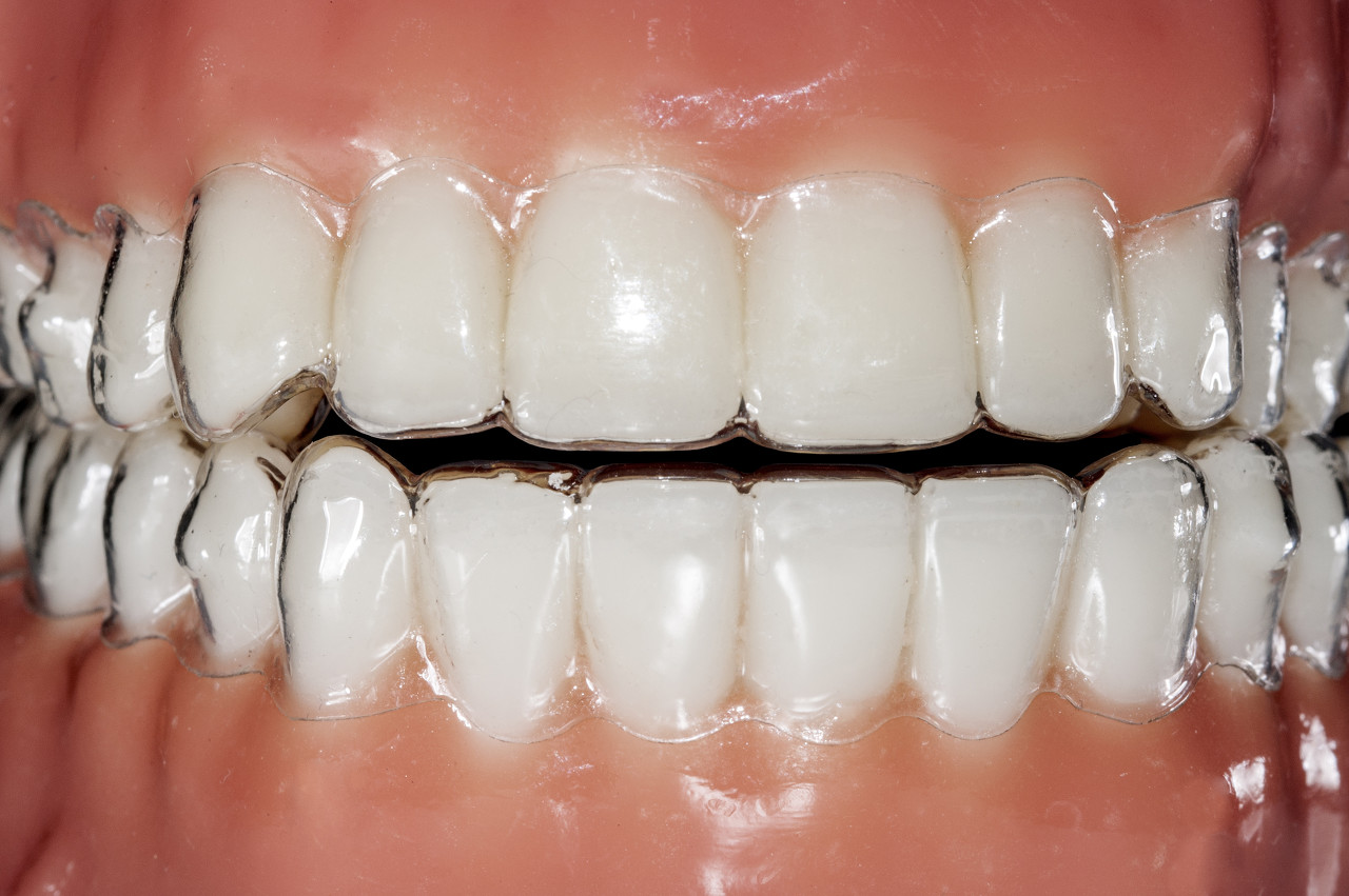 35岁女的牙齿矫正要注意什么？
