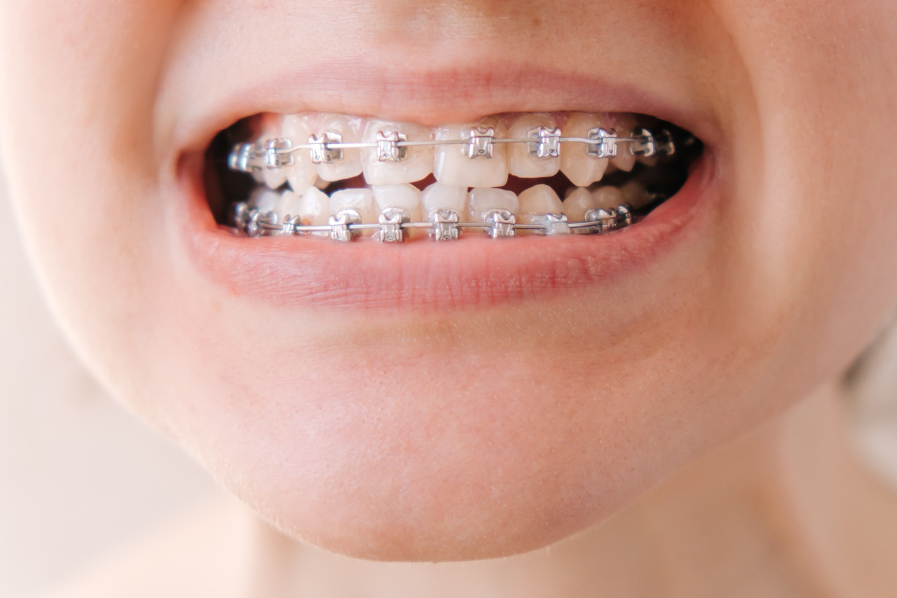 深圳牙齿矫正的年龄和价格是多少？