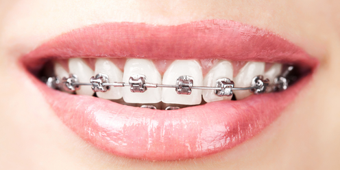 什么是牙齿矫正？牙齿矫正的流程是怎样的？