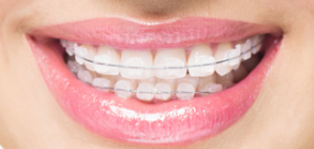什么牙齿情况需要牙齿矫正？深圳爱康健牙齿矫正多少钱一颗？