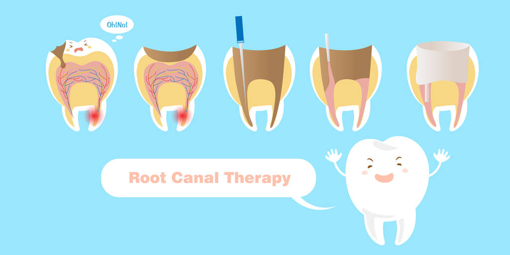 牙齿的根管治疗能保存多长时间？深圳牙齿根管治疗价格？