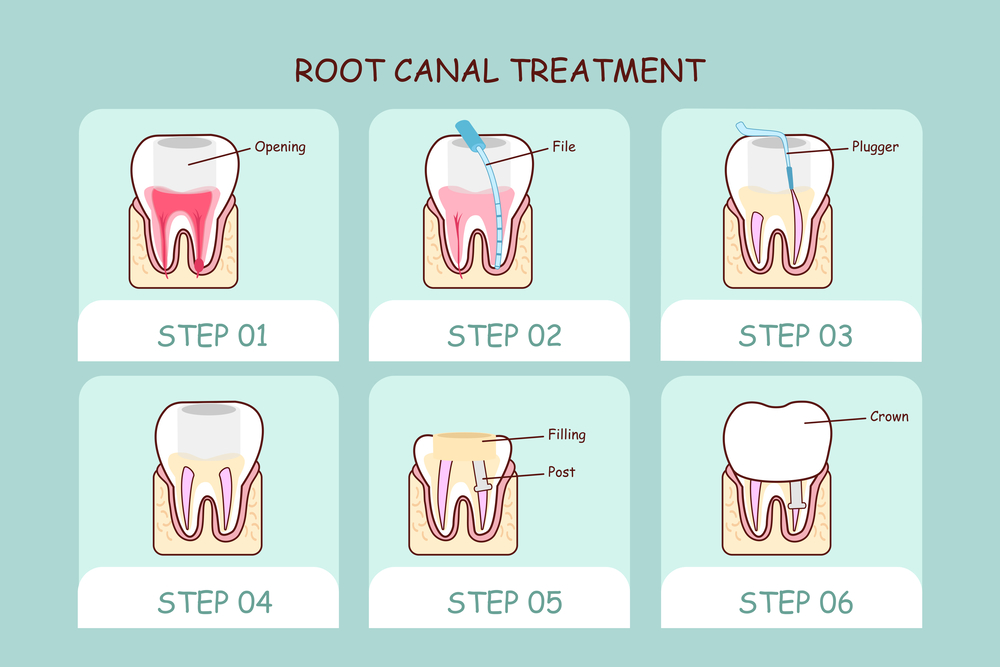 牙齿的根管治疗是什么？深圳牙齿根管治疗费用？