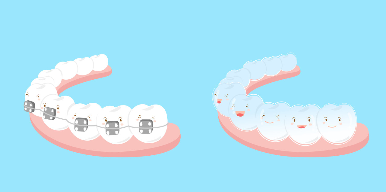 什么是牙套脸?牙套脸如何预防和恢复？