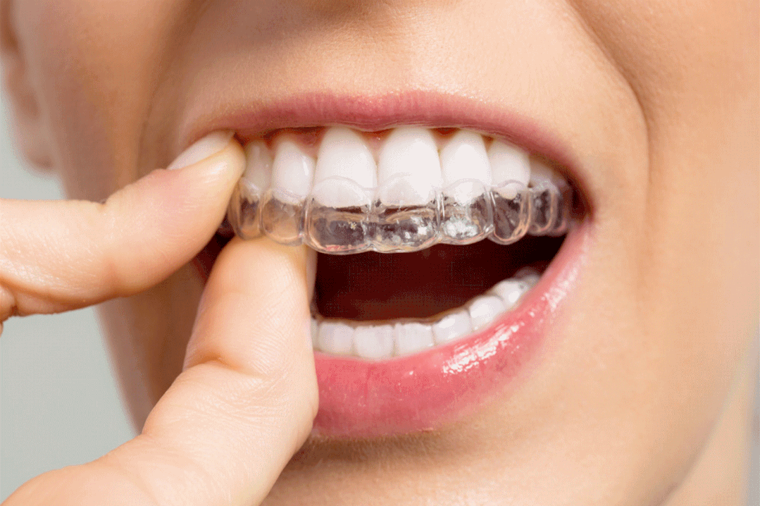 为什么戴牙套还要挂皮筋？深圳爱康健口腔牙齿矫正低至8800元！
