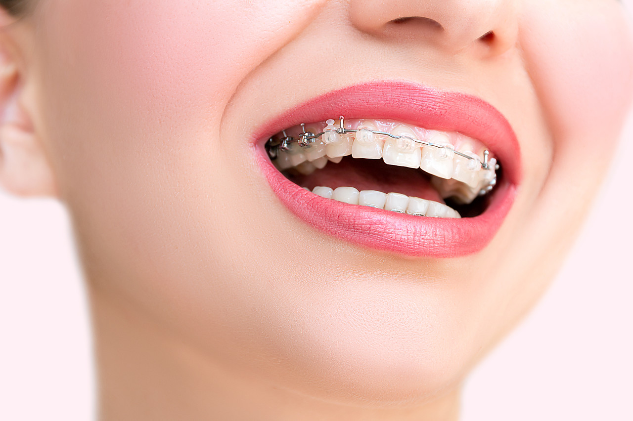 牙齿矫正可以只矫正上排牙么？深圳哪里牙齿矫正比较靠谱？