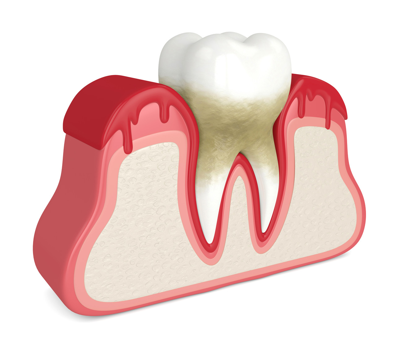 如何治疗牙周病？深圳牙周炎治疗可以医保报销吗？