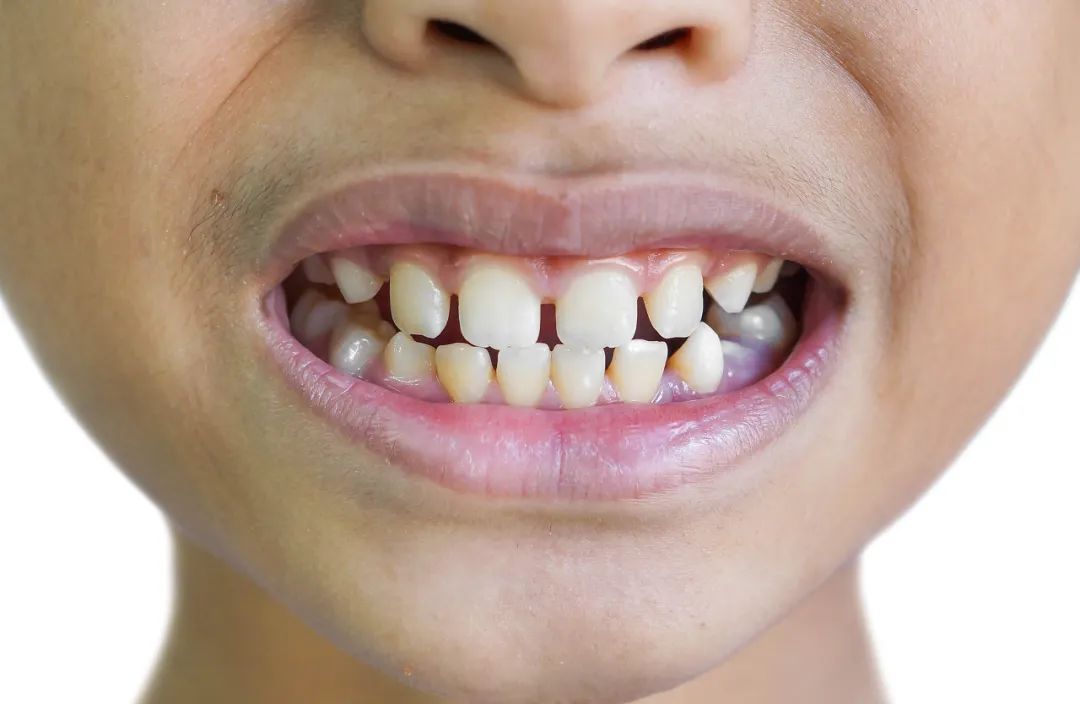 有必要进行儿童早期矫治吗？深圳爱康健口腔牙齿矫正低至8800元！