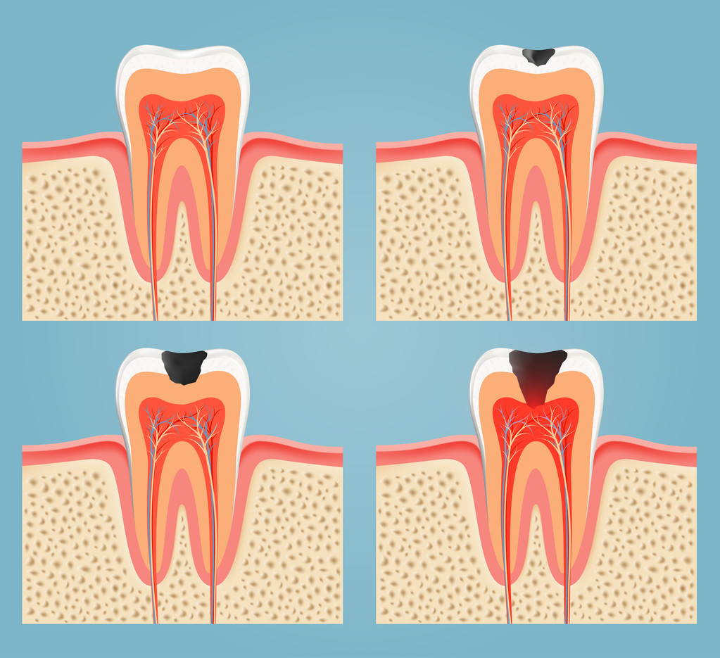 牙齿上有黑线是蛀牙吗？深圳蛀牙可以用二级医保吗？