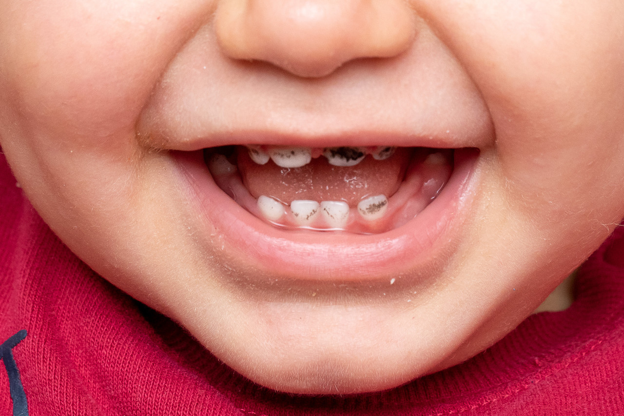儿童乳牙龋齿需要治疗吗？深圳蛀牙可以用二级医保吗能报销吗多少？