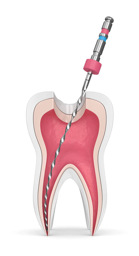 牙医的根管是怎么操作的