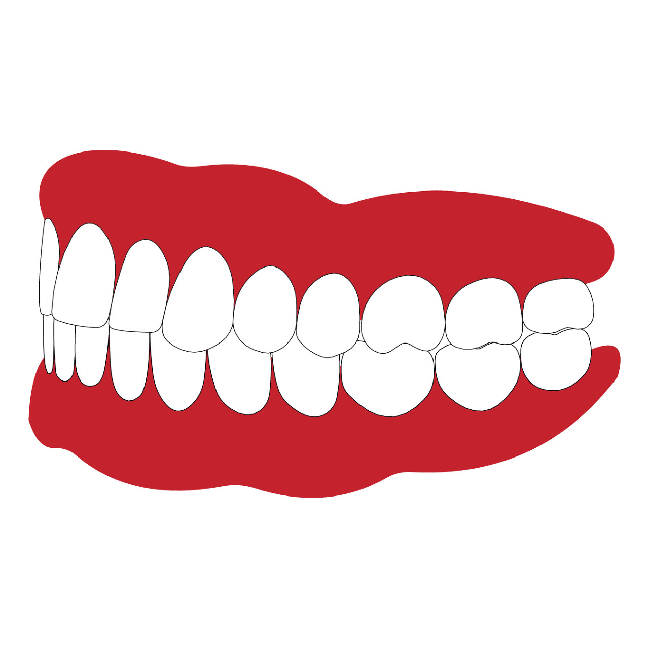 牙齿颈部楔状缺损怎么修复