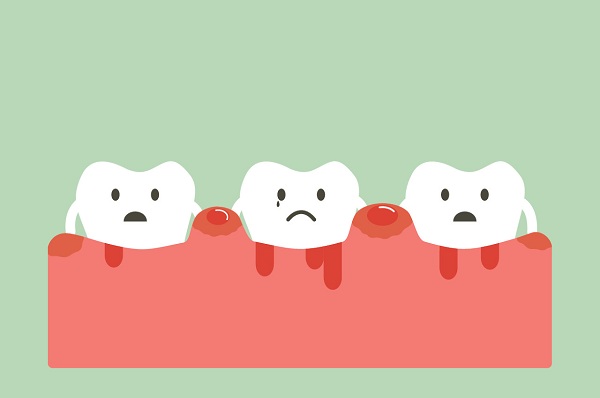 慢性牙周炎平日里应该注意些什么