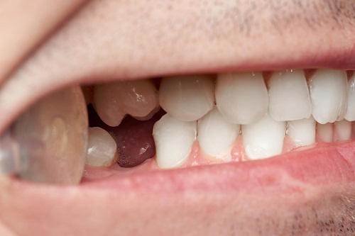 牙齦萎縮還可以植牙嗎