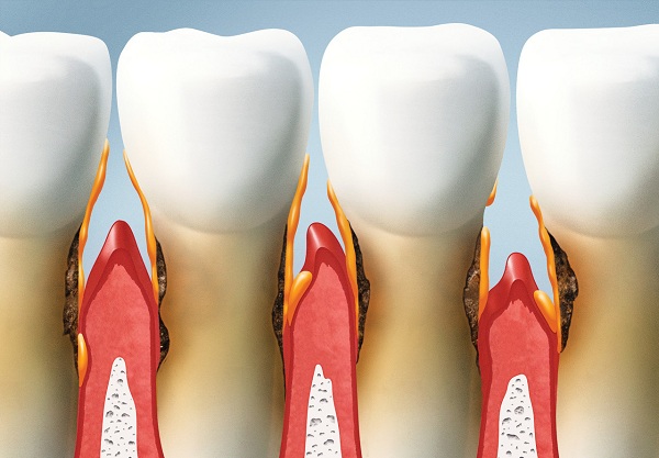 牙周炎各階段癥狀表現