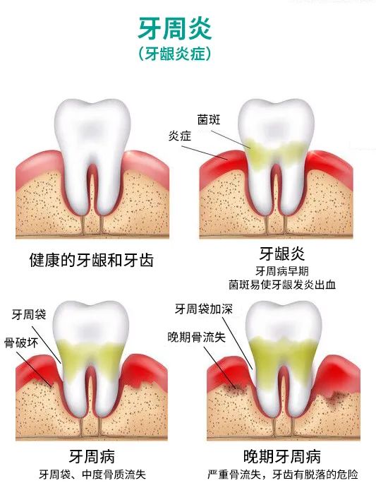 为什么会得牙周炎？深圳爱康健口腔牙周治疗优惠价限时抢！！！