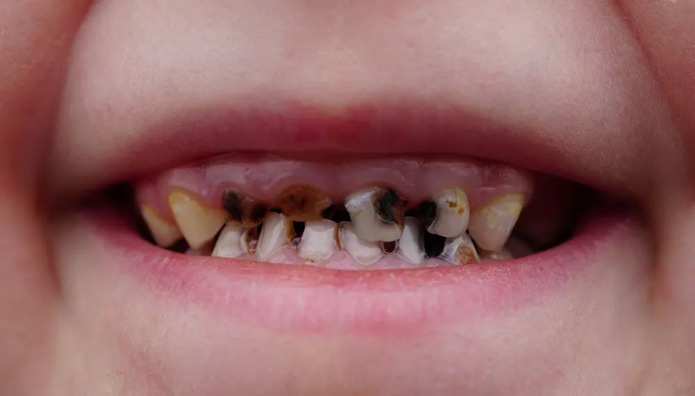 碳酸饮料腐蚀牙齿图片图片
