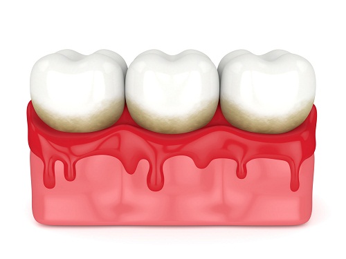 牙周炎的治疗方法是怎么样的