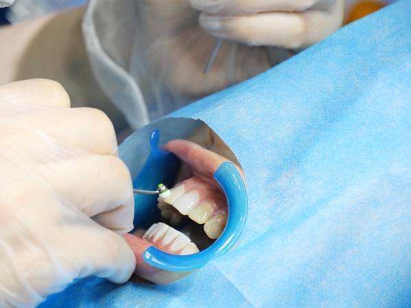 深層洗牙和普通洗牙有何不同