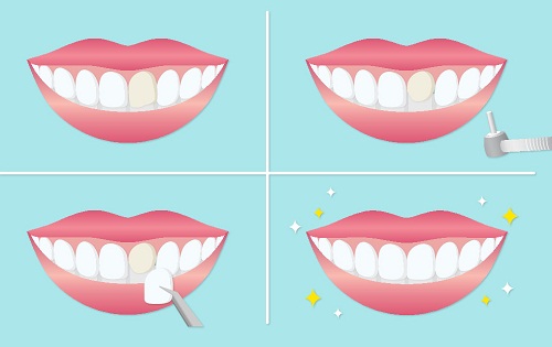 深圳牙齒貼片價格