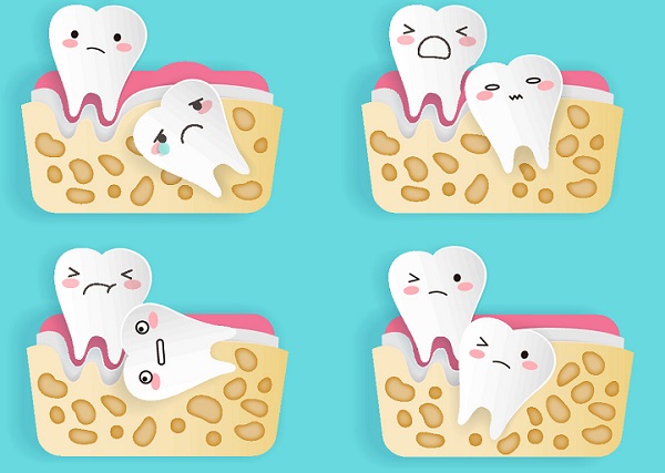 智齒蛀了補還是拔