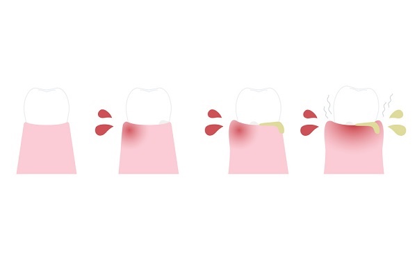 深圳牙周炎治療多少錢