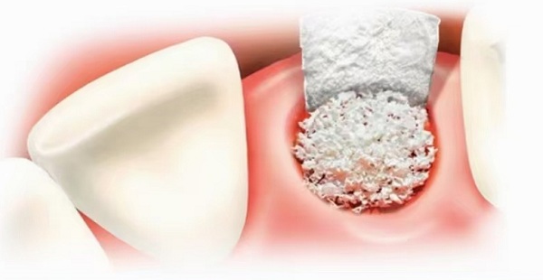 深圳種植牙多少錢一顆