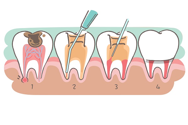 深圳杜牙根費用