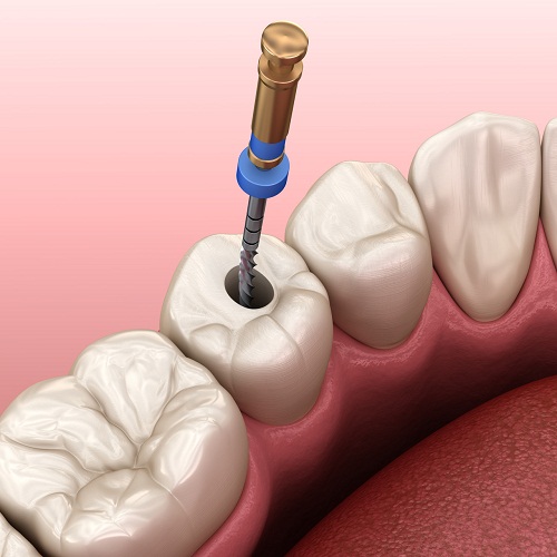 深圳杜牙根多少錢